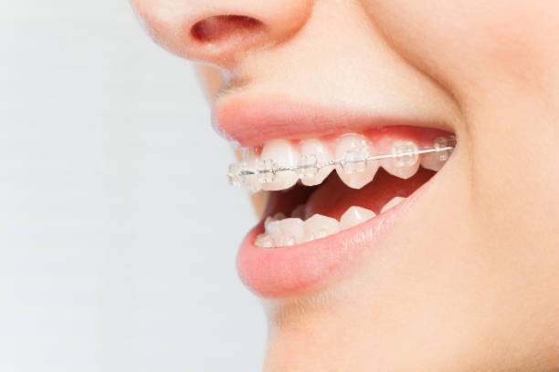 Dental Braces Adelaide Breaking the Stigma Around Orthodontics