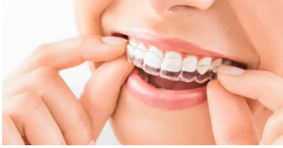 Invisalign Adelaide- How It Fits into Adelaide’s Busy Professional Lifestyle