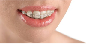 Dental Braces Adelaide’ Completely Hidden Orthodontics for Professionals